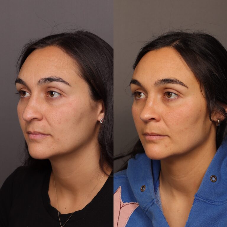 Before Image: Rhinoplasty by Dr. Thompson - front
