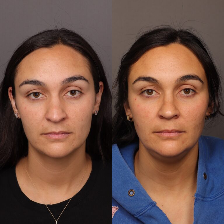After Image: Rhinoplasty by Dr. Thompson - front