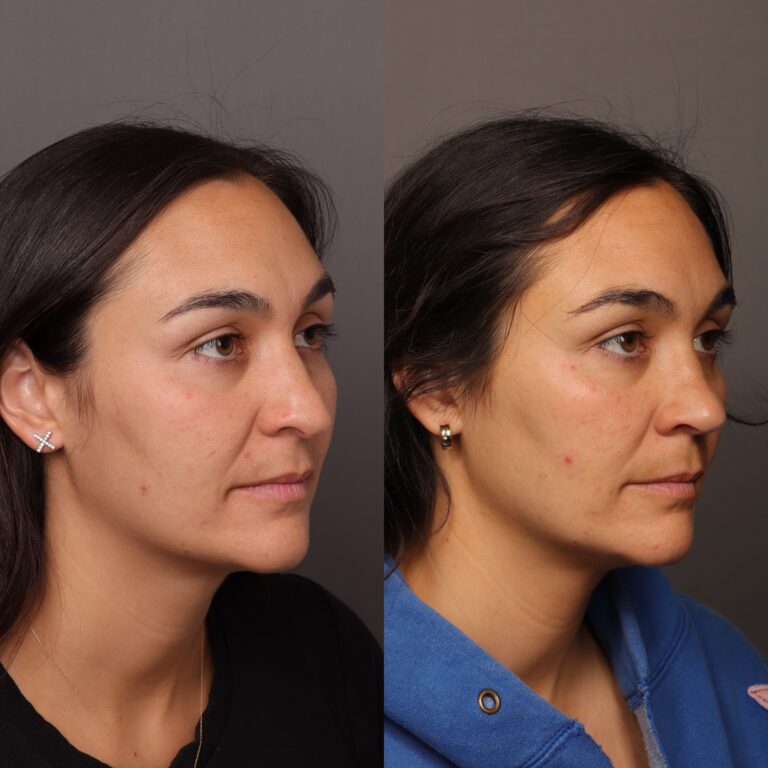 After Image: Rhinoplasty by Dr. Thompson - front