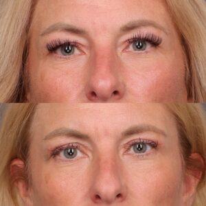 Before Image: Upper Blepharoplasty by Dr. Thompson