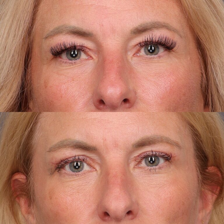Before Image: Upper Blepharoplasty by Dr. Thompson - front
