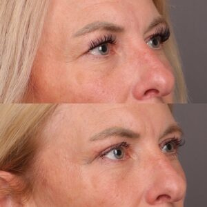 After Image: Upper Blepharoplasty by Dr. Thompson
