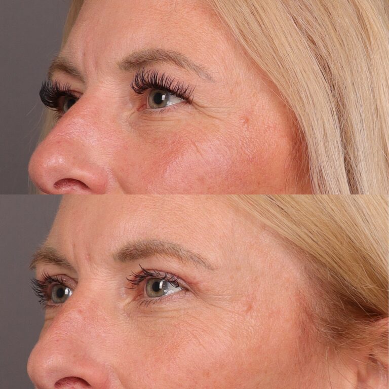 Before Image: Upper Blepharoplasty by Dr. Thompson - 