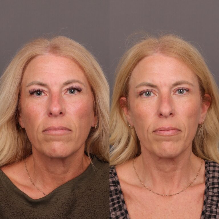 After Image: Upper Blepharoplasty by Dr. Thompson - 