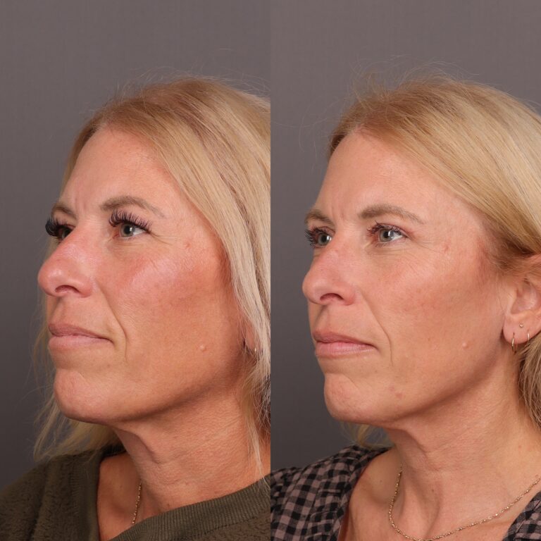 After Image: Upper Blepharoplasty by Dr. Thompson - 