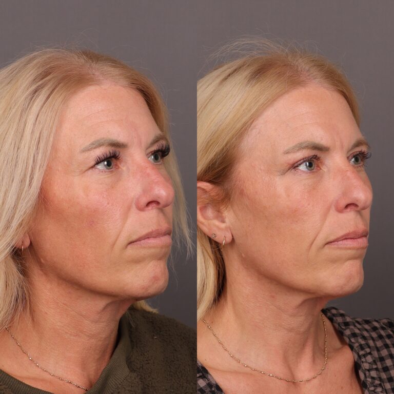 Before Image: Upper Blepharoplasty by Dr. Thompson - 