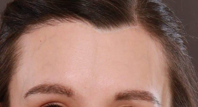 After Image: FUT Eyebrow Hair Transplant - front