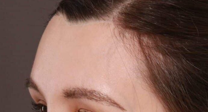 After Image: FUT Eyebrow Hair Transplant - 