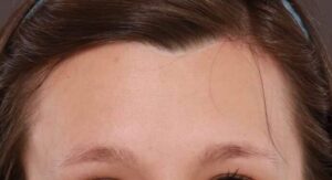 Before Image: FUT Eyebrow Hair Transplant