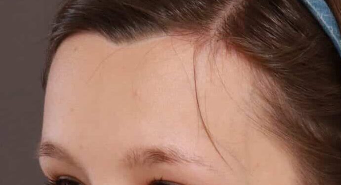 Before Image: FUT Eyebrow Hair Transplant - 