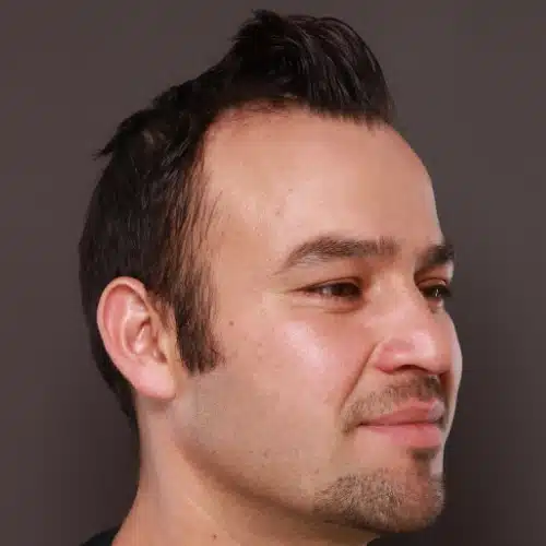 Before Image: FUE Hair Transplant, 1400 grafts - front