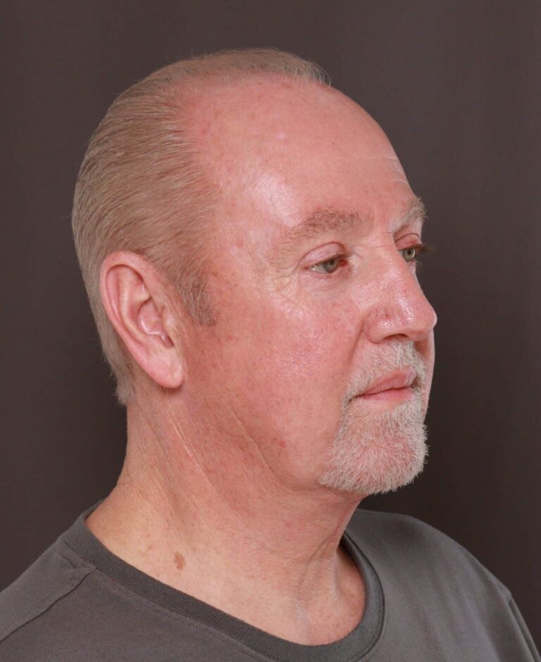 Neck Lift Results at Utah Facial Plastics