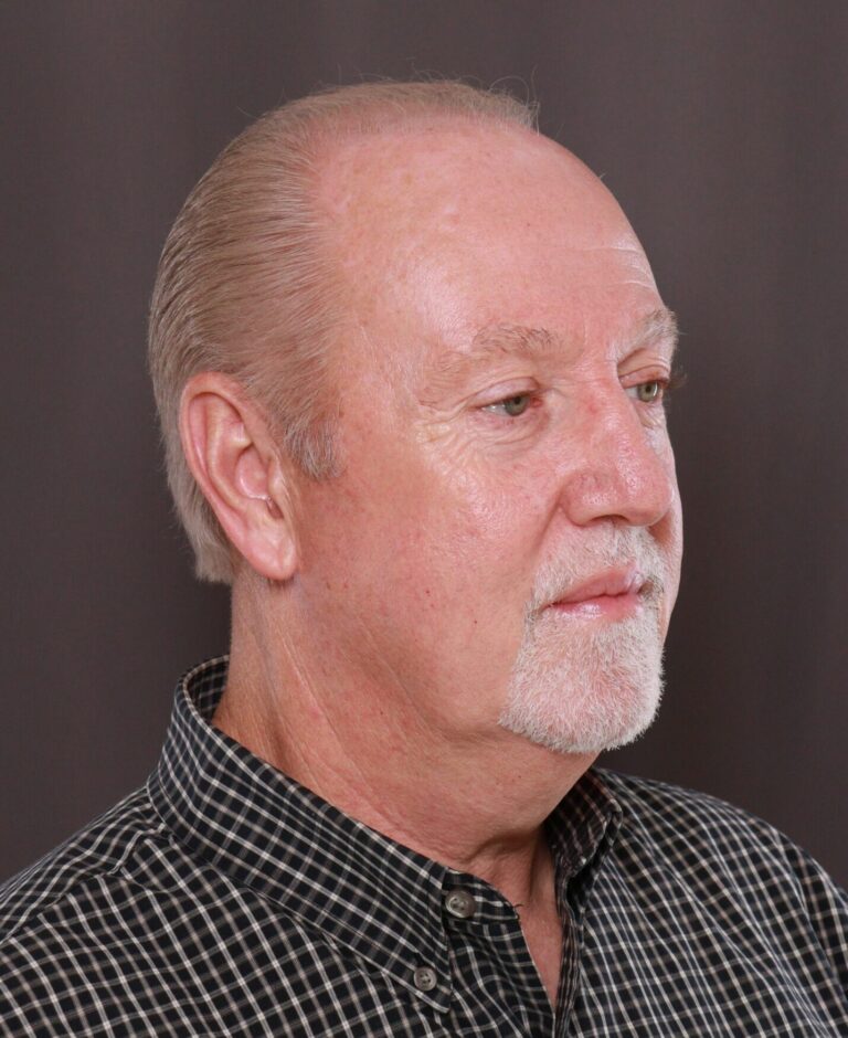 Neck Lift Results at Utah Facial Plastics