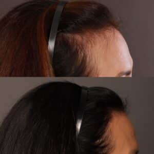 Before Image: Hair Transplant, 700 grafts