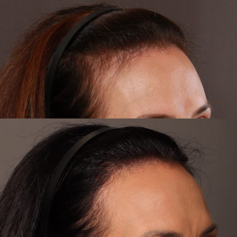 Before Image: Hair Transplant, 700 grafts - 