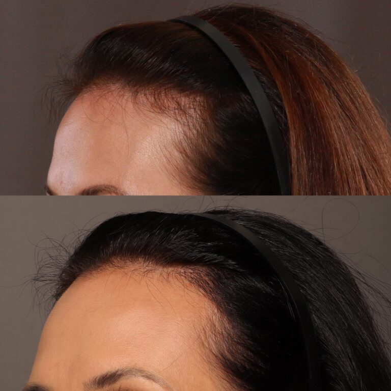 After Image: Hair Transplant, 700 grafts - 