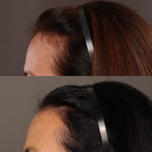 After Image: Hair Transplant, 700 grafts