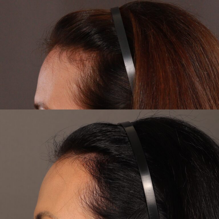After Image: Hair Transplant, 700 grafts - front