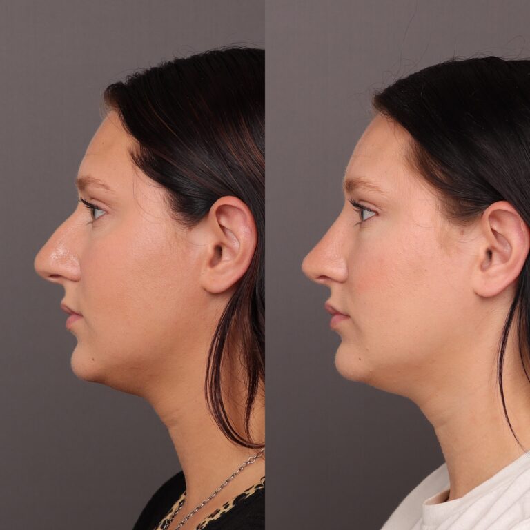 After Image: Rhinoplasty - 