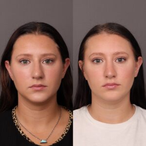Before Image: Rhinoplasty