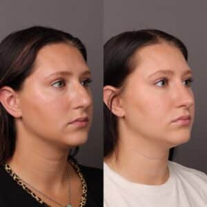 After Image: Rhinoplasty