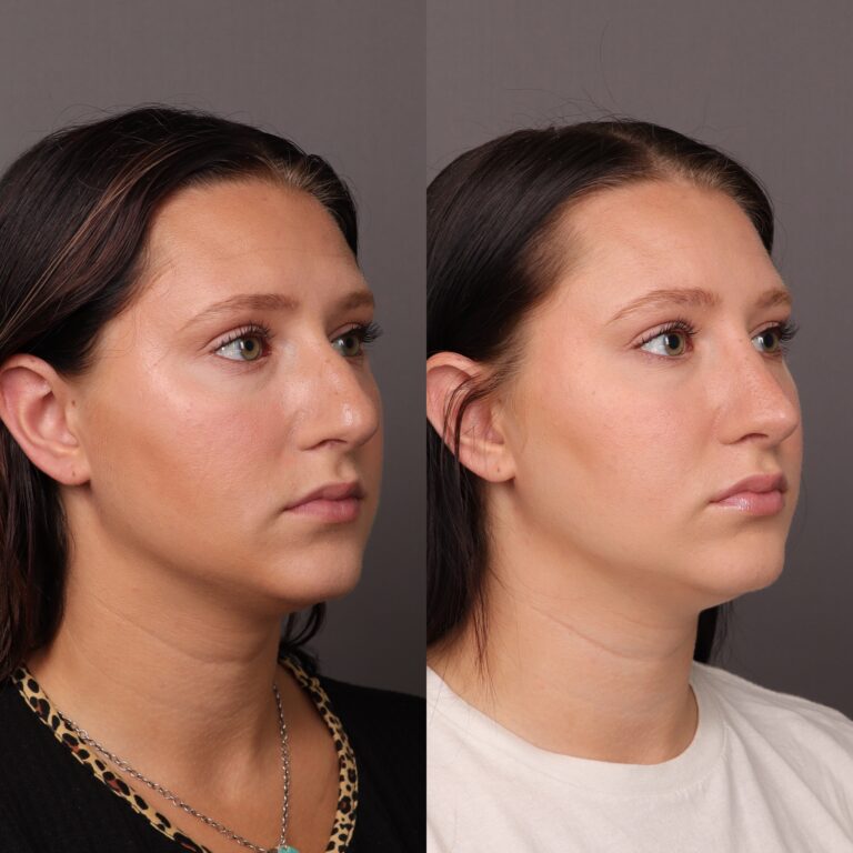 After Image: Rhinoplasty - front
