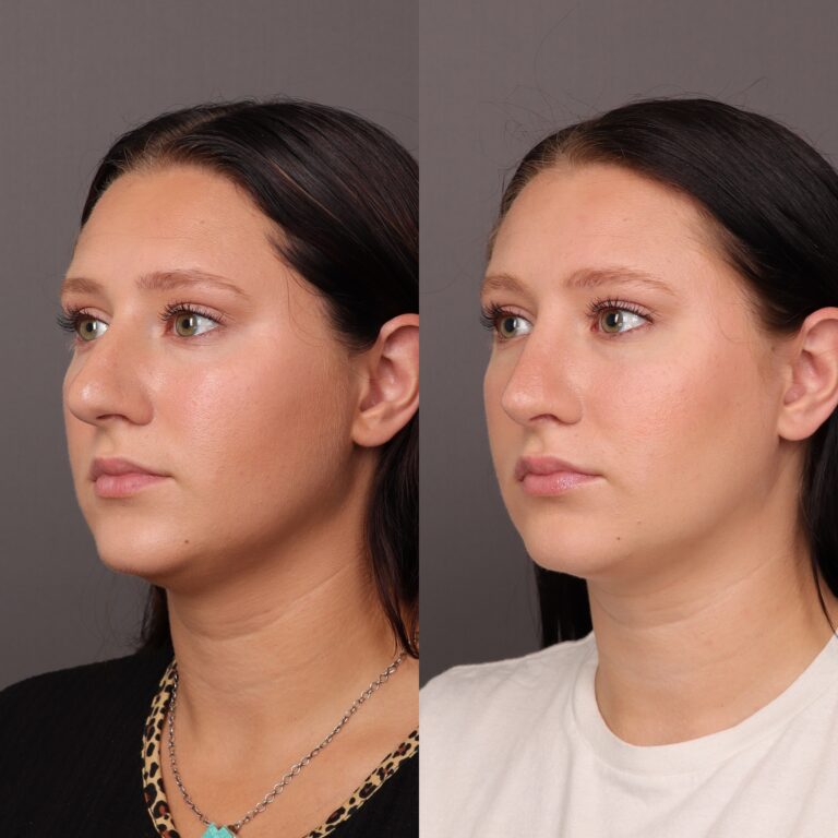 Before Image: Rhinoplasty - 