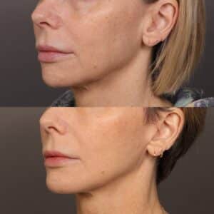 After Image: Chin Implant, MACs Lift & Fat Grafting
