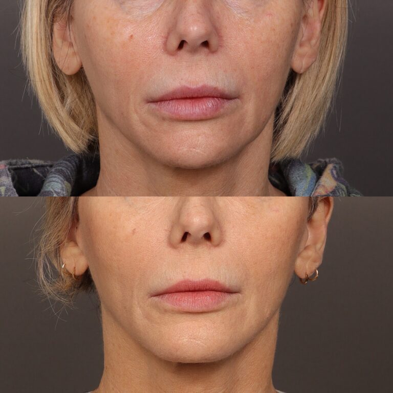 Before Image: Chin Implant, MACs Lift & Fat Grafting - other