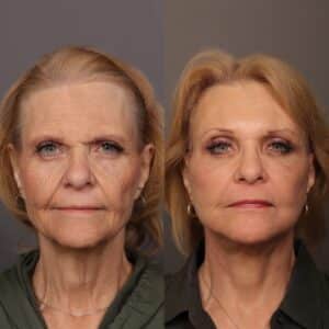 Before Image: Facelift, Endoscopic Browlift, Fat Grafting & Contour TRL