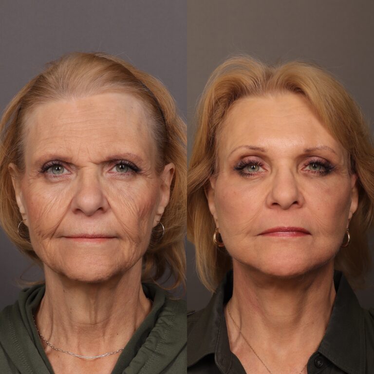 Before Image: Facelift, Endoscopic Browlift, Fat Grafting & Contour TRL - front