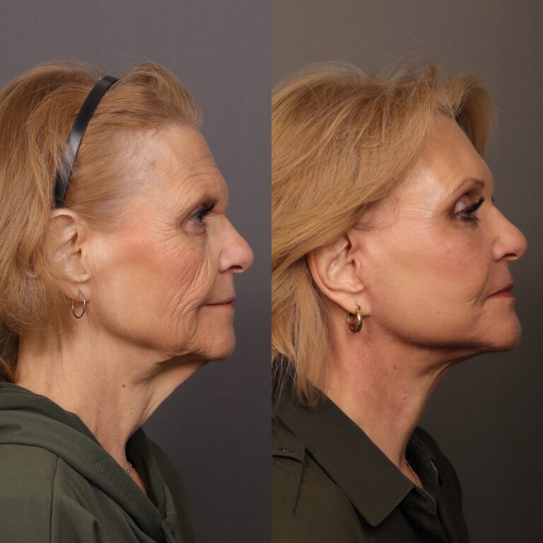 Before Image: Contour TRL - front