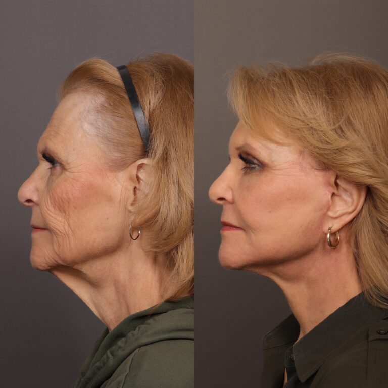 After Image: Contour TRL - front