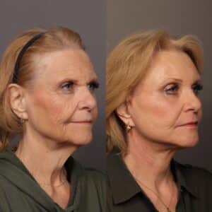 After Image: Facelift, Endoscopic Browlift, Fat Grafting & Contour TRL