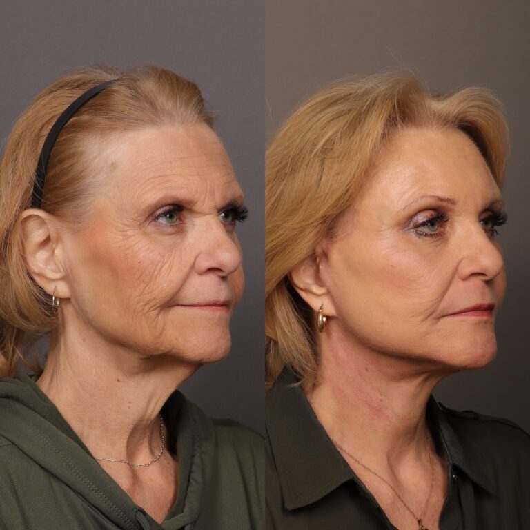 After Image: Facelift, Endoscopic Browlift, Fat Grafting & Contour TRL - front