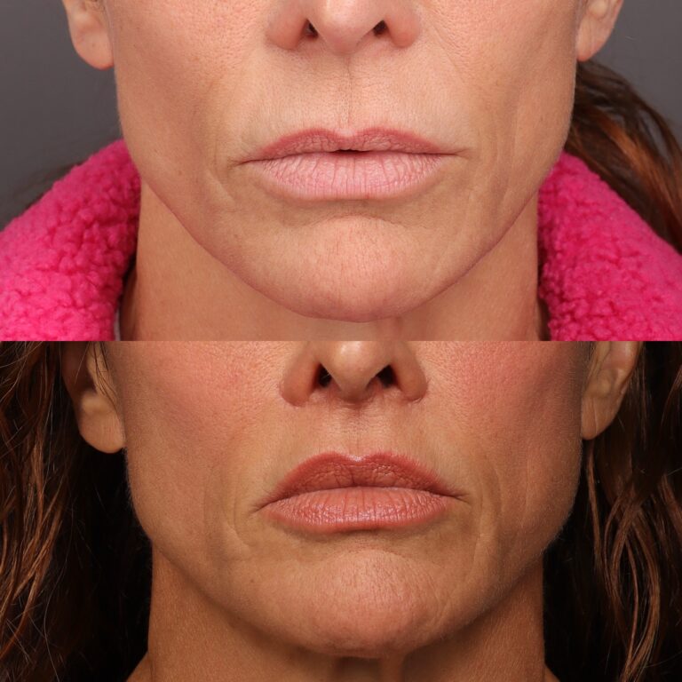 Before Image: Lip Lift - front