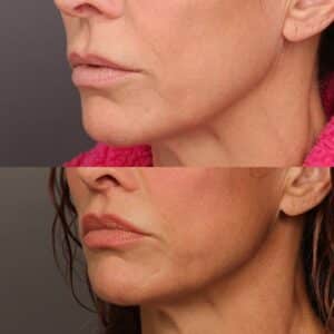 After Image: Lip Lift