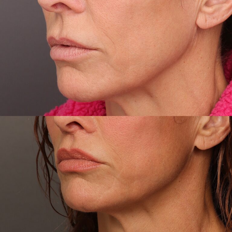 After Image: Lip Lift - front