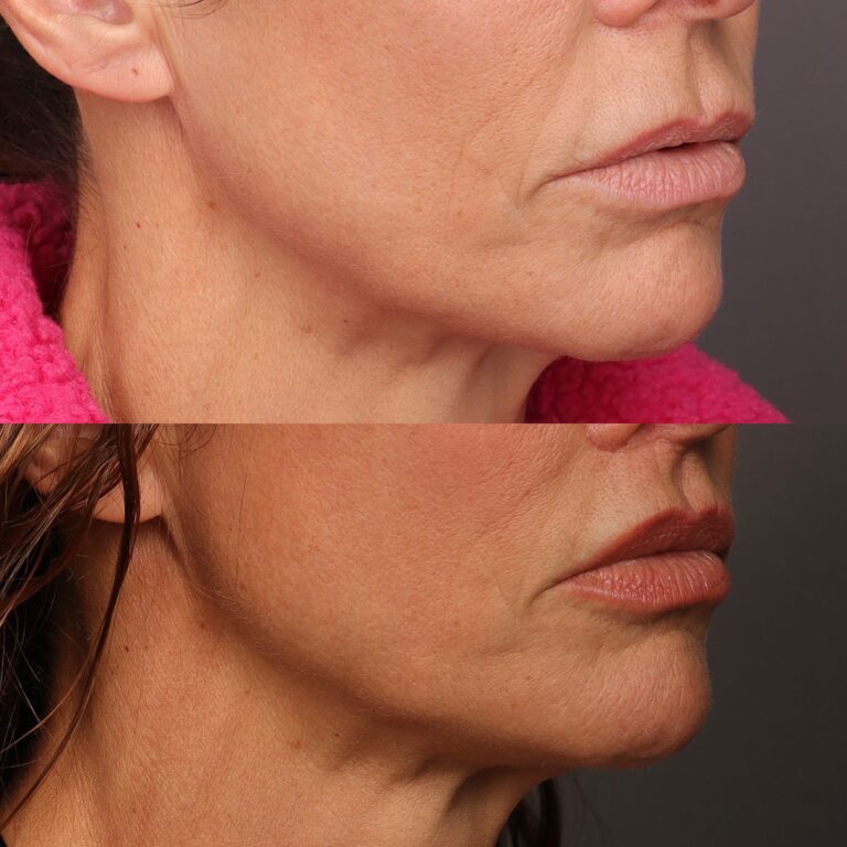 Before Image: Lip Lift - 