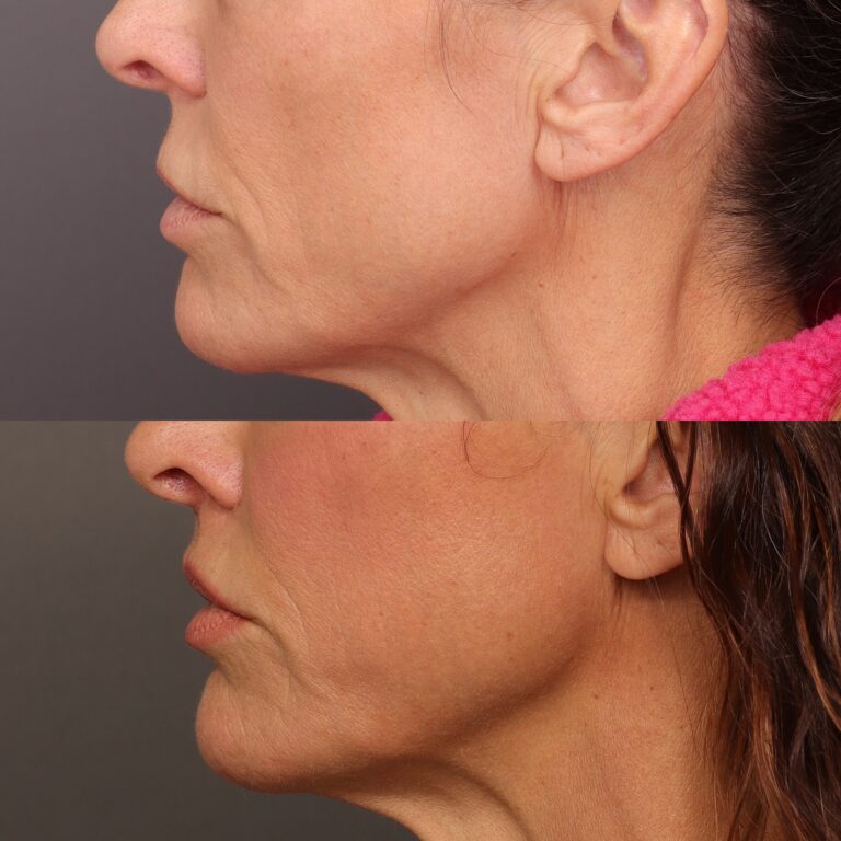 After Image: Lip Lift - 