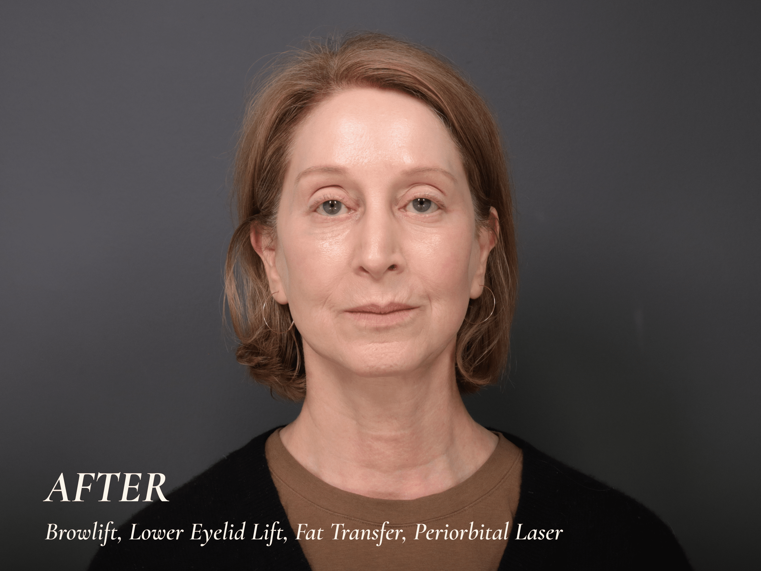 Dr Hall Eyelid Lift (2)