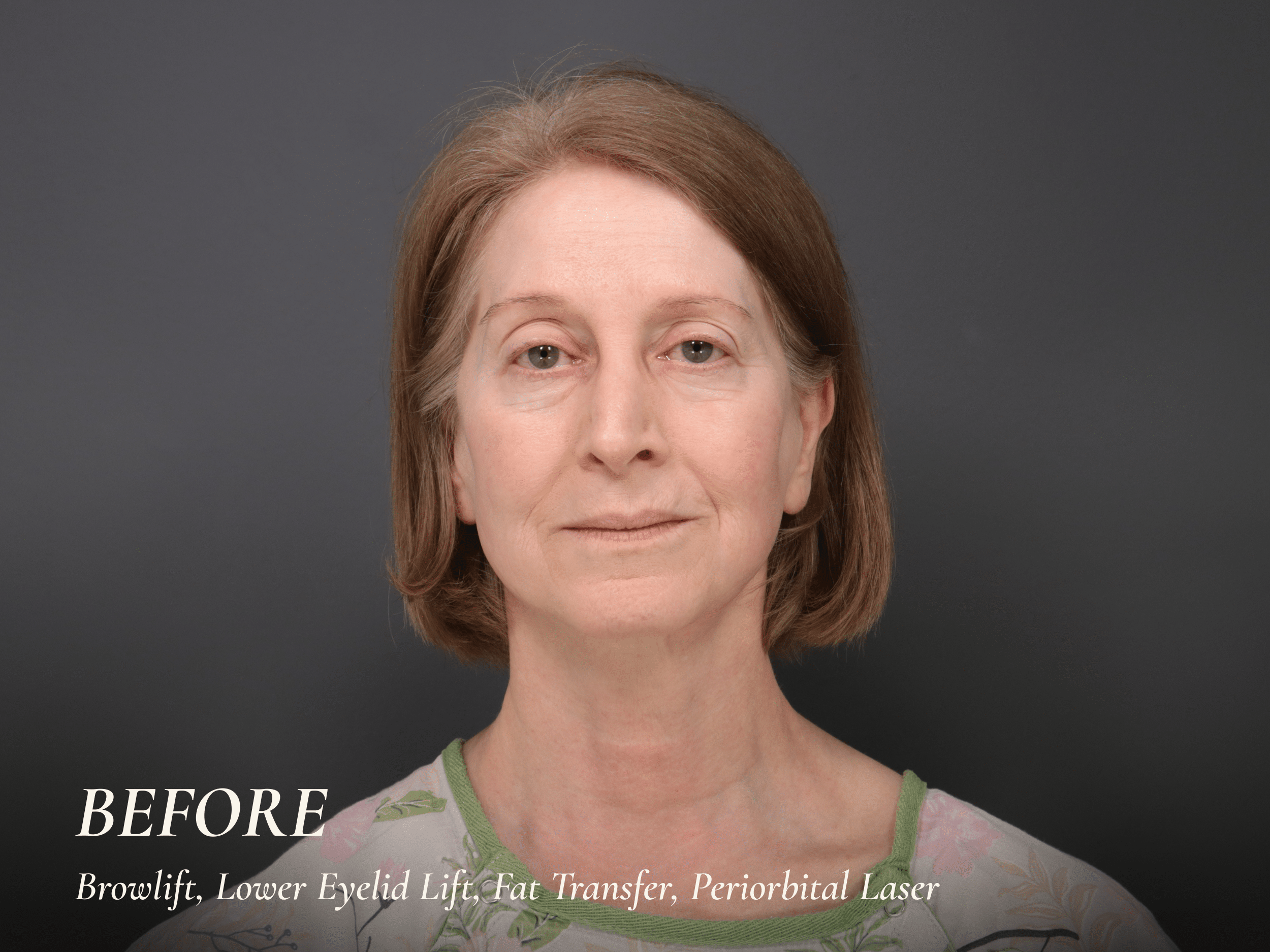 Dr Hall Eyelid Lift