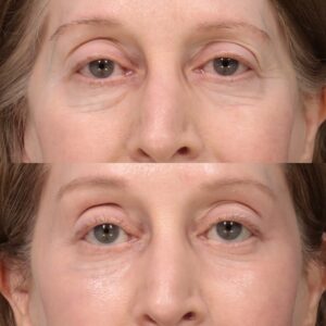 After Image: Upper & Lower Blepharoplasty, Fat Grafting & Laser Resurfacing