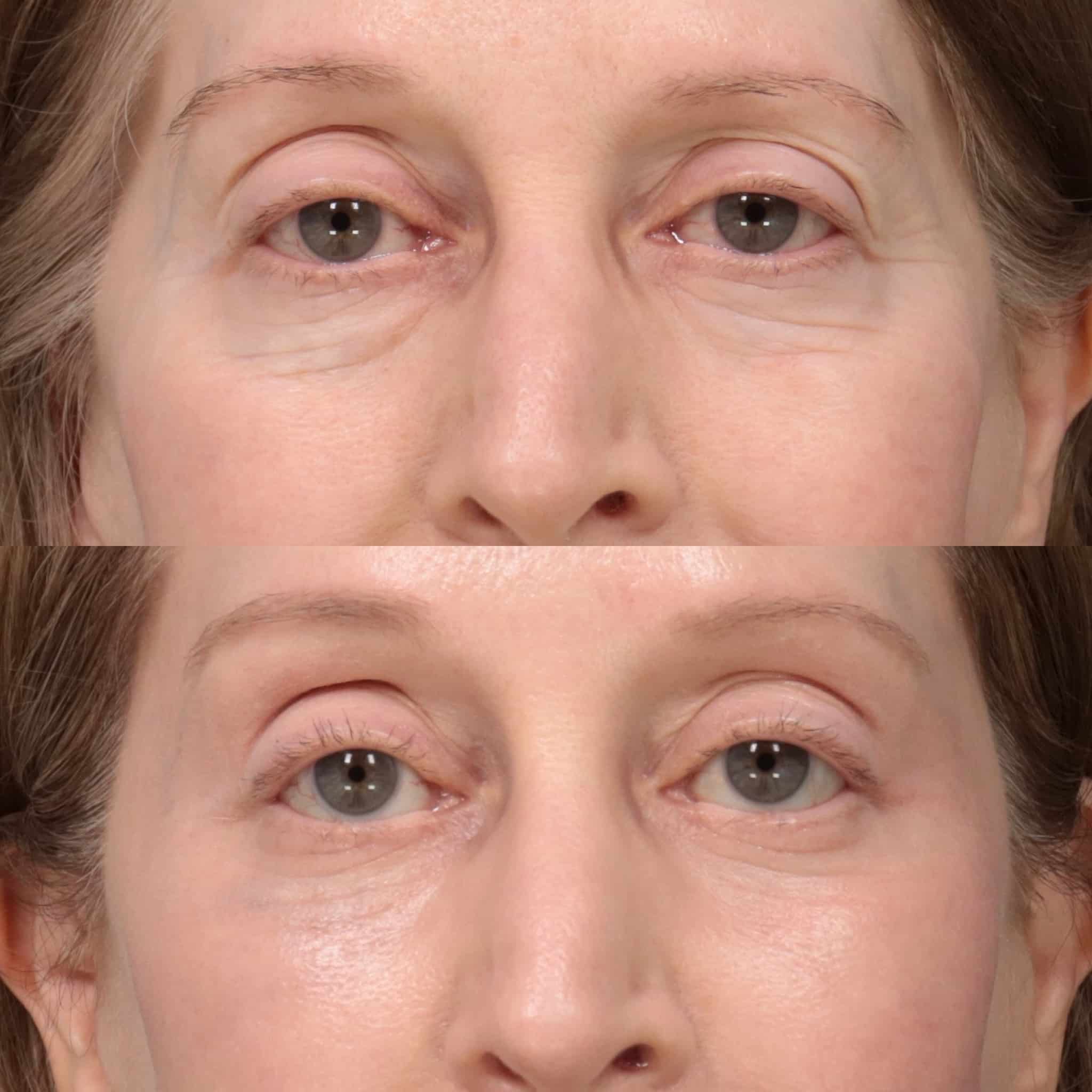 Before & After of Upper Lower Blepharoplasty