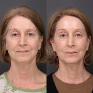 Before Image: Upper & Lower Blepharoplasty, Fat Grafting & Laser Resurfacing
