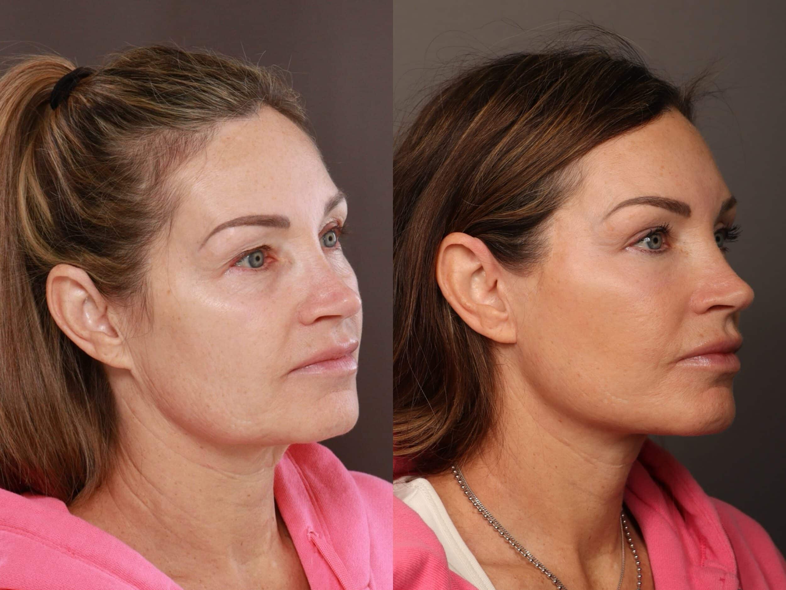Deep Plane Facelift, Upper & Lower Blepharoplasty, and Fat Grafting by Dr. Thompson. 1.5 years post-operative. Age 57. Utah Facial Plastics Draper Cosmetic Surgery.