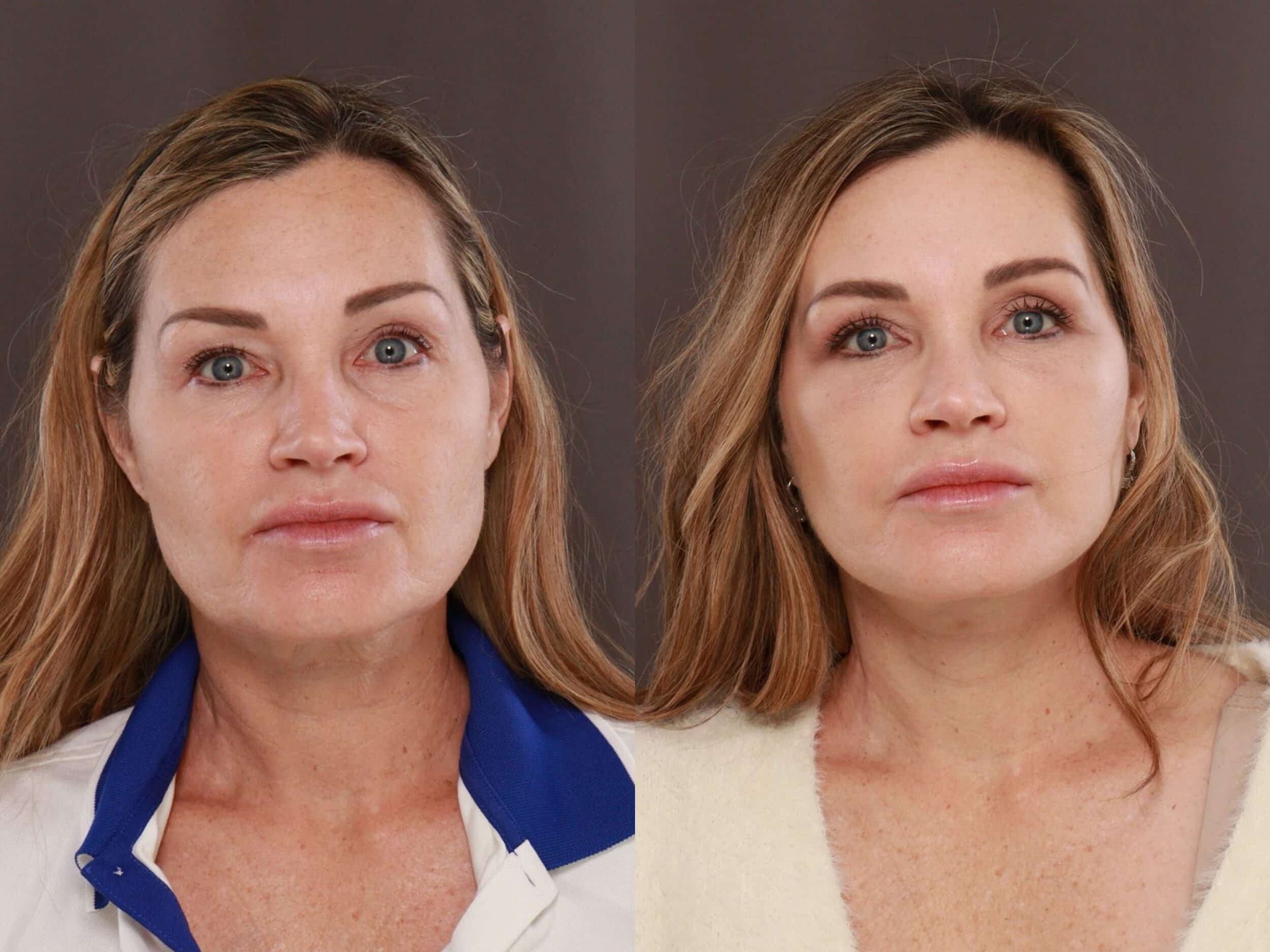 Deep Plane Facelift, Upper & Lower Blepharoplasty, and Fat Grafting by Dr. Thompson. 1.5 years post-operative. Age 57. Utah Facial Plastics Draper Cosmetic Surgery.