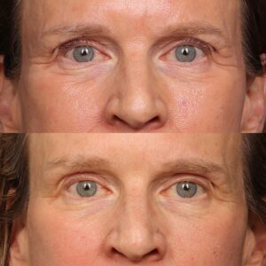 Before Image: Botox & Skinvive