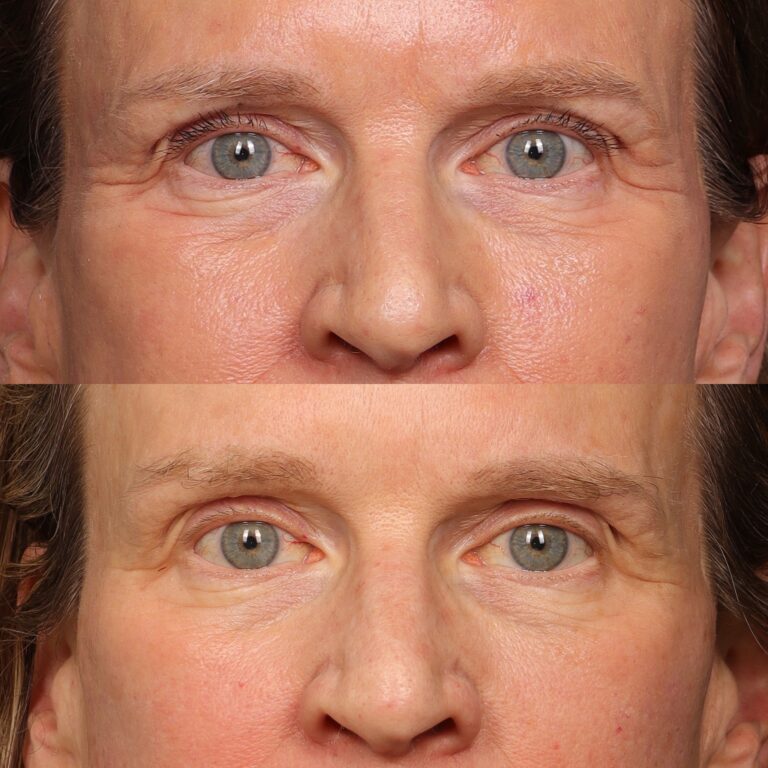 Before Image: Botox & Skinvive - front
