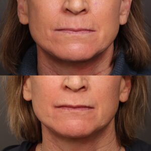 After Image: Botox & Skinvive